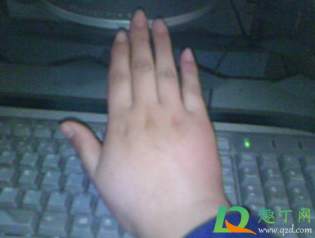 为什么冬天手冻了之后会变粗(手冻了会变粗吗)