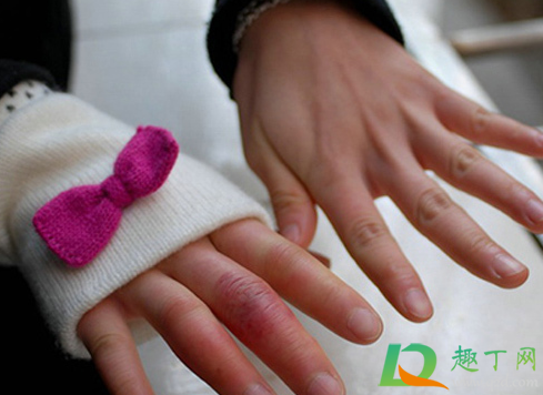 手一到冬天就冻伤怎么办(冬天手受伤冻了怎么办)