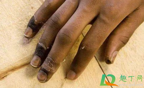 冬天冻疮把手冻变形了怎么办(冬天手得了冻疮怎么办)