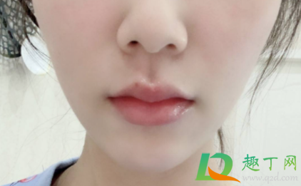 嘴角干裂口缺什么维生素(嘴干裂口子缺什么维生素)