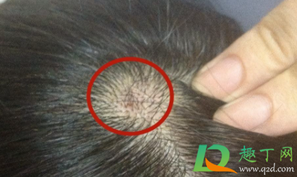 头皮长痘可以擦红霉素吗(头皮长痘可以涂红霉素软膏吗) 头皮长痘可以擦红霉素吗(头皮长痘可以涂红霉素软膏吗)