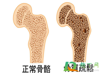 骨质疏松只补钙行不行(骨质疏松不缺钙用补钙吗) 骨质疏松只补钙行不行(骨质疏松不缺钙用补钙吗)