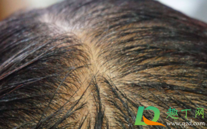 头皮长痘可以擦红霉素吗(头皮长痘可以涂红霉素软膏吗) 头皮长痘可以擦红霉素吗(头皮长痘可以涂红霉素软膏吗)