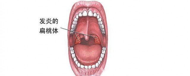 扁桃体发炎可以尝试这样做(让扁桃体发炎的方法)