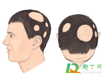 一小块斑秃会自愈吗(斑秃刚发现一小块 会持续吗) 一小块斑秃会自愈吗(斑秃刚发现一小块 会持续吗)