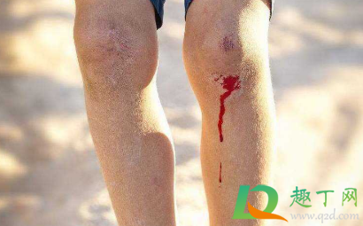 一点点擦伤怎么处理(擦伤的常见处理方法一点一滴) 一点点擦伤怎么处理(擦伤的常见处理方法一点一滴)