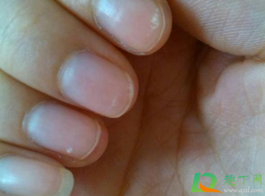 指甲里有白色斑块是为什么(大拇指指甲里有白色斑块是为什么)
