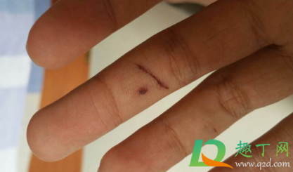 伤口有脏东西会长到肉里吗(伤口有污垢会长在肉里吗) 伤口有脏东西会长到肉里吗(伤口有污垢会长在肉里吗)