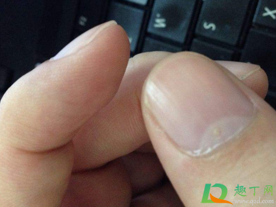 指甲里有白色斑块是为什么(大拇指指甲里有白色斑块是为什么)