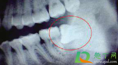 智齿横着长拔牙有风险吗(智齿横生拔牙有危险吗) 智齿横着长拔牙有风险吗(智齿横生拔牙有危险吗)
