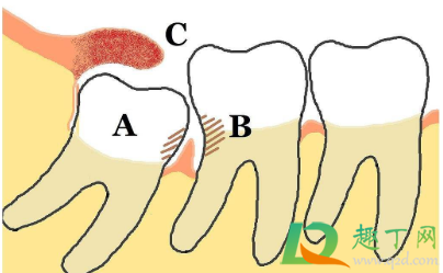 智齿横着长拔牙有风险吗(智齿横生拔牙有危险吗)