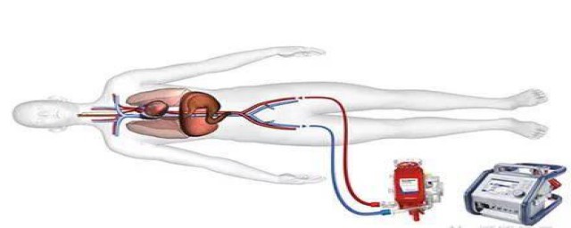 ecmo是什么(ECMO是什么)