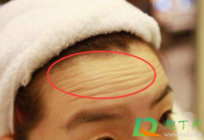 抬头纹怎么去除简单方法(“抬头纹怎么去除”)