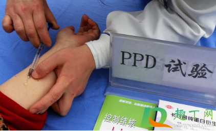 ppd是什么检查怎么做(ppd检查是怎么检查)