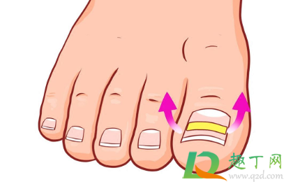 甲沟炎如何自己处理(轻度甲沟炎如何自己处理) 甲沟炎如何自己处理(轻度甲沟炎如何自己处理)