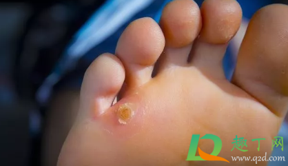 鸡眼怎么去除最好方法脚上(鸡眼怎么去除最好方法脚上六个小方法) 鸡眼怎么去除最好方法脚上(鸡眼怎么去除最好方法脚上六个小方法)