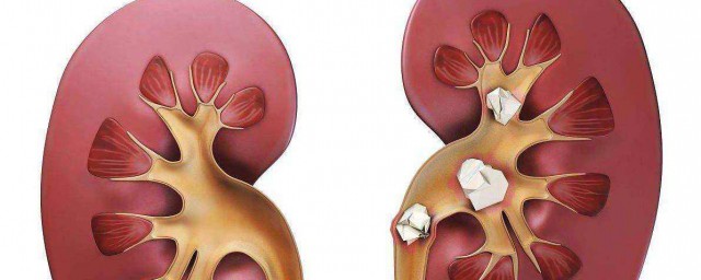 应该怎么治疗呢(痛风应该怎么治疗呢)