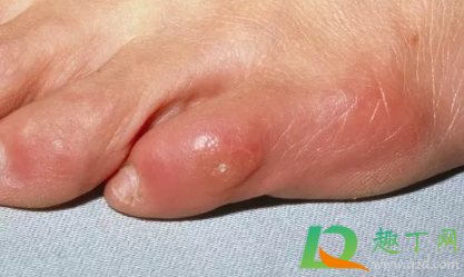 鸡眼怎么去除最好方法脚上(鸡眼怎么去除最好方法脚上六个小方法)