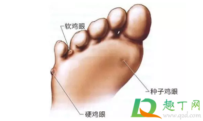 鸡眼怎么去除最好方法脚上(鸡眼怎么去除最好方法脚上六个小方法) 鸡眼怎么去除最好方法脚上(鸡眼怎么去除最好方法脚上六个小方法)