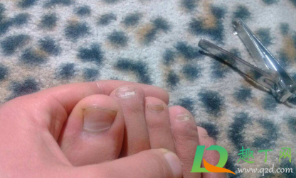 甲沟炎如何自己处理(轻度甲沟炎如何自己处理) 甲沟炎如何自己处理(轻度甲沟炎如何自己处理)