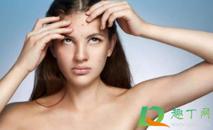 痘印怎么去除效果好(痘印怎么有效去除)