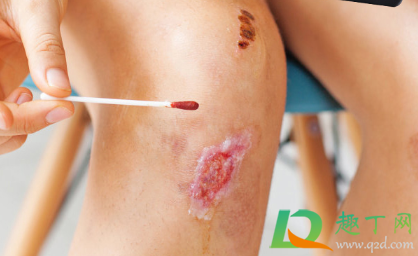 手上碘酒用什么能洗掉(碘酒弄手上洗不掉)