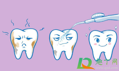 牙结石可以自己抠掉吗(洗牙) 牙结石可以自己抠掉吗(洗牙)