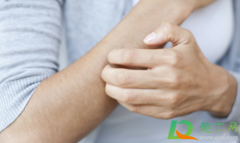 为什么会突然得了荨麻疹(湿疹)