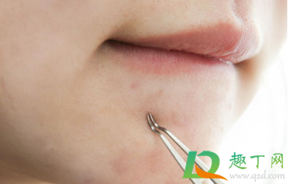 下巴闭口粉刺怎么去除(下巴闭口粉刺怎么可以有效的去除)