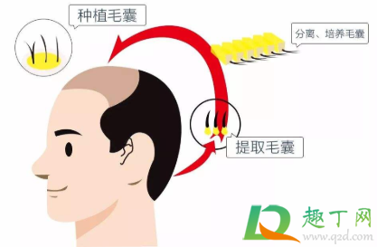 植发可以维持多久呢(植发可以维持多久呢百度知道) 植发可以维持多久呢(植发可以维持多久呢百度知道)