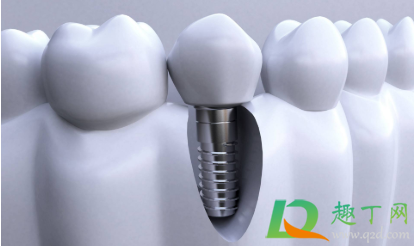 种植牙效果是终身的吗(种植牙可以维持一辈子吗)