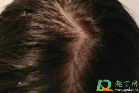头皮屑多有可能传染吗(头皮屑多头皮屑会传染吗)