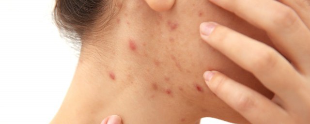 这些攻略真的是祛痘的及时雨(10种你意想不到的祛痘绝招)