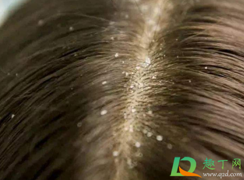 头皮屑多有可能传染吗(头皮屑多头皮屑会传染吗)