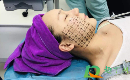 热玛吉五代做一次多少钱(热玛吉五代做一次多少钱一次)