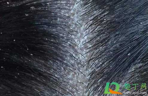 头皮屑多有可能传染吗(头皮屑多头皮屑会传染吗)