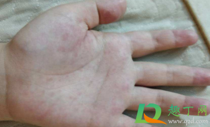 手心手掌奇痒无比是什么原因(手掌心和手指头奇痒无比)