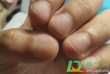 指甲盖掀翻出血怎么办(指甲盖掀翻了怎么办) 指甲盖掀翻出血怎么办(指甲盖掀翻了怎么办)