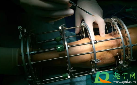 断骨增高失败终身残疾什么情况(断骨增高7年后残废)