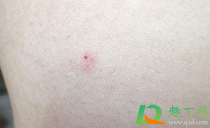 手臂的小红点是什么原因(手臂出现小红点是什么原因) 手臂的小红点是什么原因(手臂出现小红点是什么原因)