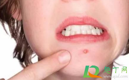 长了火疖子可以挤吗(火疖子能不能挤出来) 长了火疖子可以挤吗(火疖子能不能挤出来)