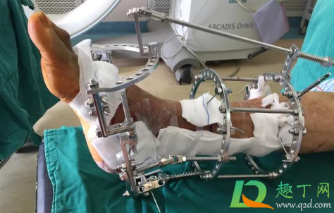 断骨增高失败终身残疾什么情况(断骨增高7年后残废) 断骨增高失败终身残疾什么情况(断骨增高7年后残废)