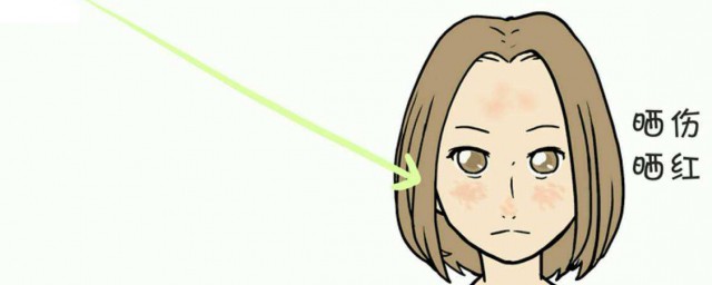 晒伤治疗方法(晒伤的处理方法)