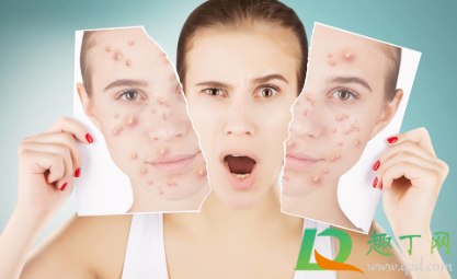 长了火疖子可以挤吗(火疖子能不能挤出来) 长了火疖子可以挤吗(火疖子能不能挤出来)