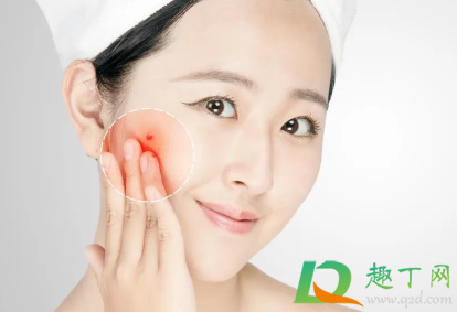 火疖子发热疼痛可以冷敷吗(火疖子可以热敷吗?) 火疖子发热疼痛可以冷敷吗(火疖子可以热敷吗?)