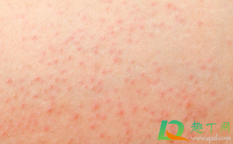 毛囊炎的图片是什么样子的(毛囊炎是什么样子的图片库)