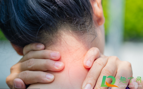 膏药过敏会自己消失吗(贴膏药过敏会自己消退吗) 膏药过敏会自己消失吗(贴膏药过敏会自己消退吗)