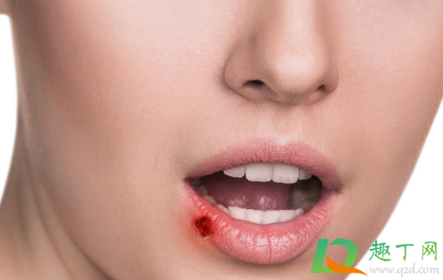 嘴唇上长疱疹怎么办(嘴唇上长疱疹怎么办还流水)