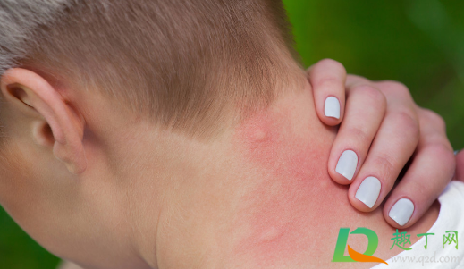 膏药过敏会自己消失吗(贴膏药过敏会自己消退吗) 膏药过敏会自己消失吗(贴膏药过敏会自己消退吗)