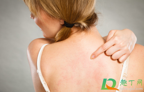 贴膏药处很痒是好还是不好(贴完膏药有点痒是好的还是不好的)